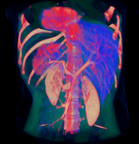 Real-time immersive medical volume rendering Real-time immersive medical volume rendering